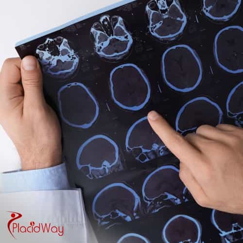 Multiple Sclerosis Stem Cell Treatments in Colombia: Affordable Options for California Tourists